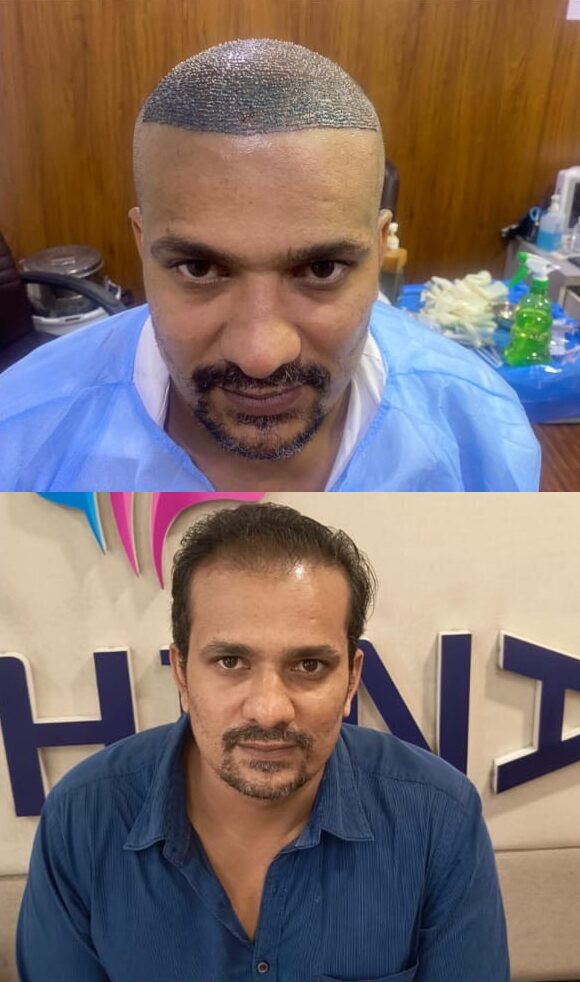 male hair transplantation